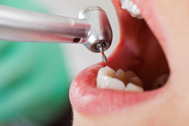 Best Urgent Care for Lost Fillings or Crowns in Rock Island, WA